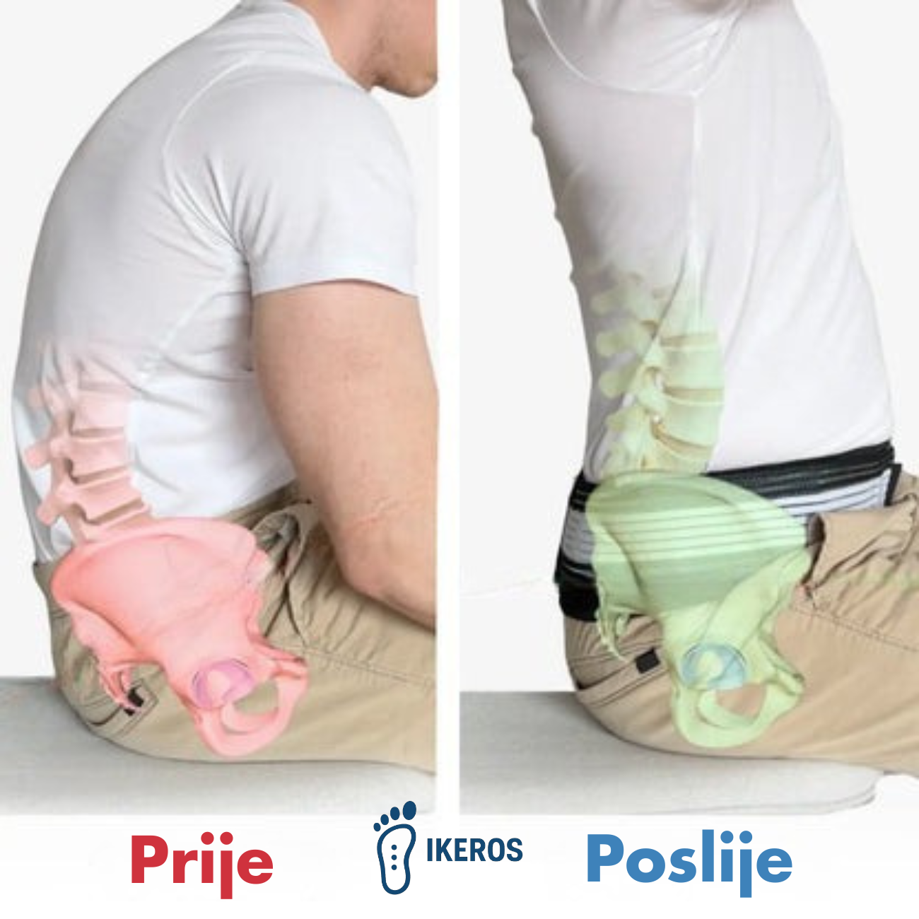 Ortopedski Pojas IKEROS™ Patite li od išijasa ili bolova u leđima?